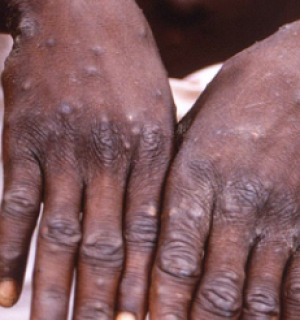 Cabinda sob alerta máximo face ao surto de varíola que assola o Congo Brazzaville