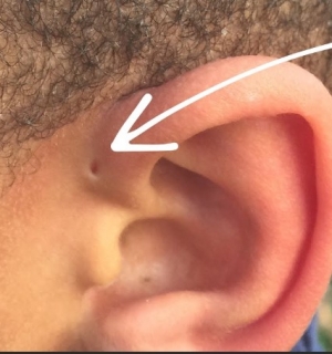 Fístulas Pré-auriculares