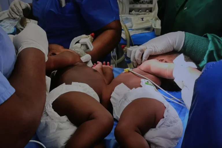 Angola regista décima cirurgia de separação de gémeos siameses