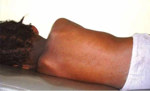 surto de sarampo em cabinda