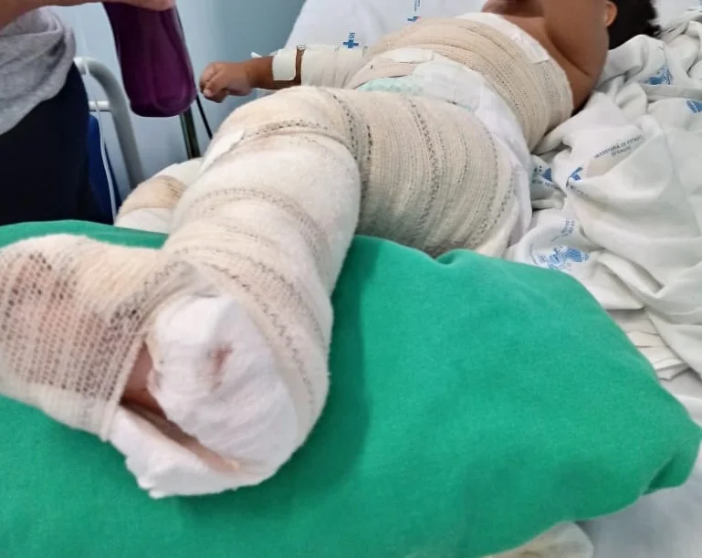 Mais de 100 crianças vítimas de queimaduras recebem cirurgia gratuita na Huíla