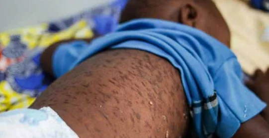 Zaire notifica 135 casos de sarampo em oito meses