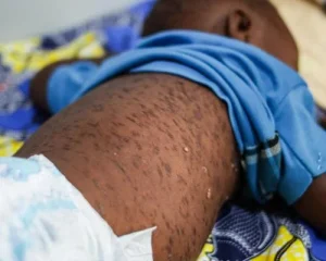 OMS anuncia eliminação do sarampo e rubéola em mais três países