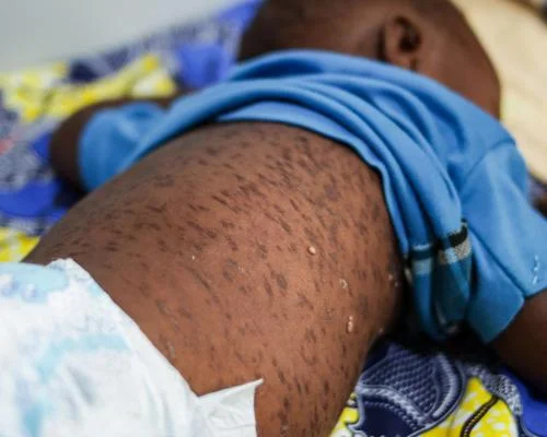 OMS anuncia eliminação do sarampo e rubéola em mais três países