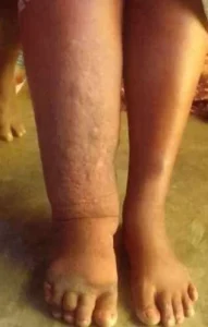 Mais de 2000 casos de doenças negligenciadas em 2025