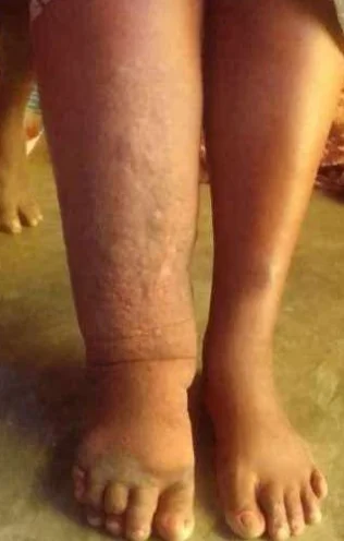 Mais de 2000 casos de doenças negligenciadas em 2025