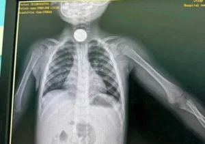 remove moeda da garganta de uma criança de seis anos.