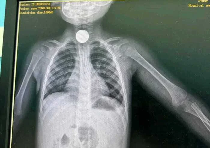 remove moeda da garganta de uma criança de seis anos.